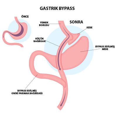 Gastrik Bypass Ameliyat Estepalace