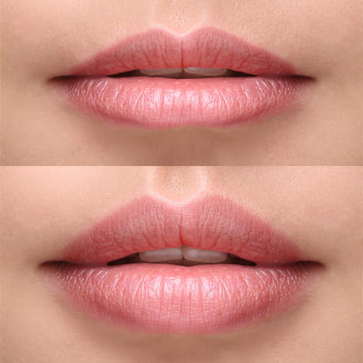 Who Are Lip fillers Suitable For?