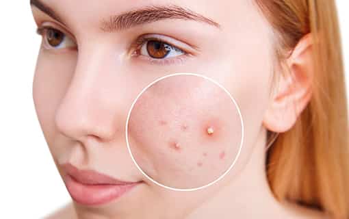 What is Acne and Pimple Treatmen estepalace