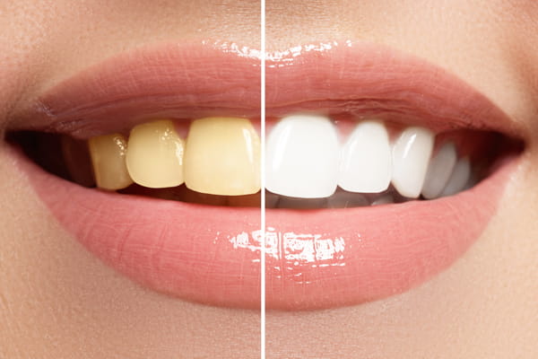 Who Is Teeth Whitening Suitable for?