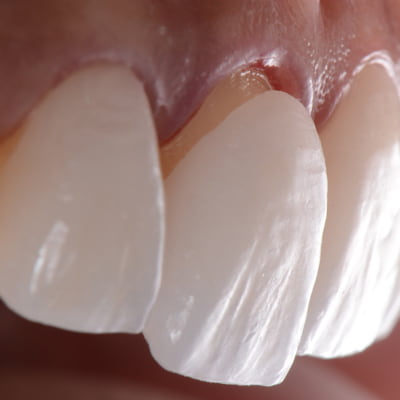 Who are Dental Veneers suitable for