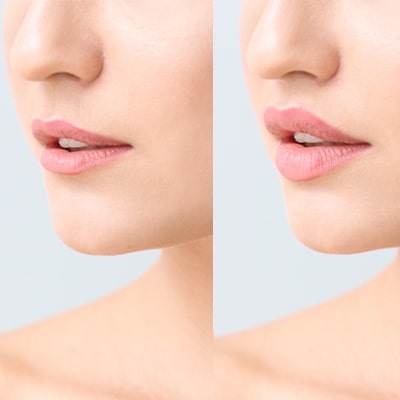 Who Is A Lip lift Suitable For?
