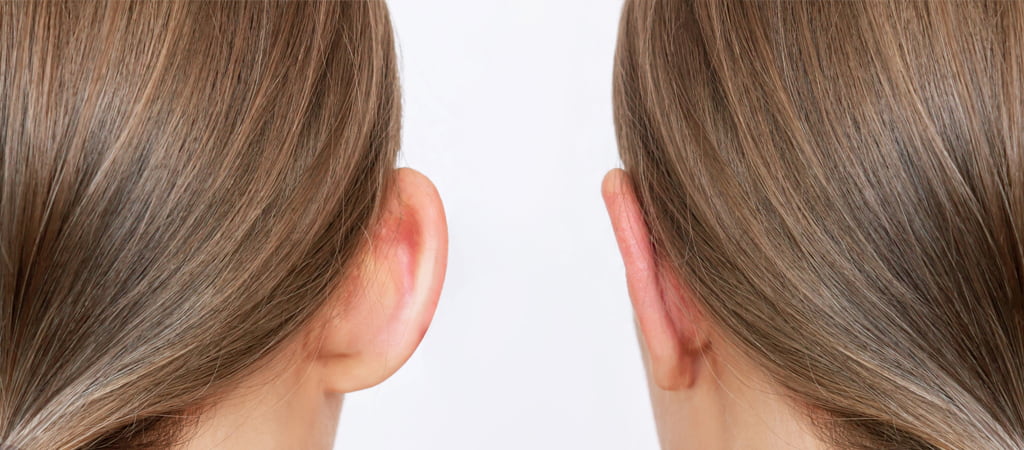 Ear Aesthetics Prominent Ears