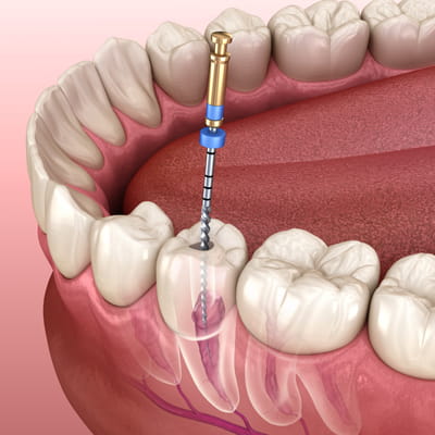 How is Root Canal Treatment Performed