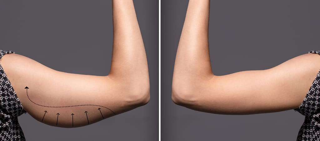 What is Brachioplasty and Thigh Lift