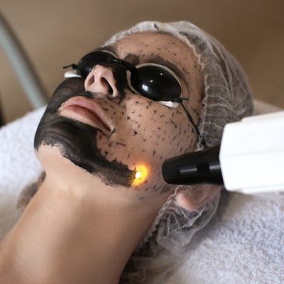 Who Is A Carbon Peeling Treatment Suitable For