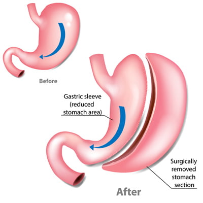 Who Is Suitable For A Gastric Sleeve Gastrectomy
